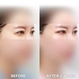Fox Eye Lift before and after results at Returning Plastic Surgery, visible eye lift after 2 weeks