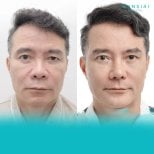 Результати до та після підтяжки обличчя у Wansiri Hospital, помітне омолодження
