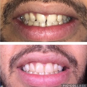 Before and after composite veneer results at Professional Dental Care Clinic, improved smile