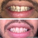 Before and after composite veneer results at Professional Dental Care Clinic, improved smile