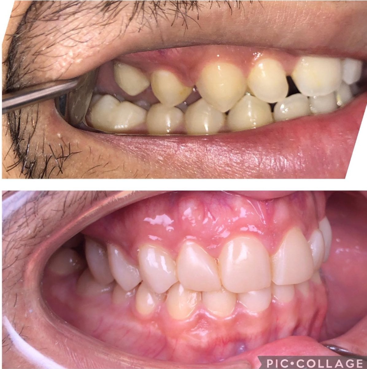 نتائج قبل وبعد فينير الكمبوزيت في Professional Dental Care Clinic، ابتسامة محسنة