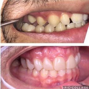 Before and after composite veneer results at Professional Dental Care Clinic, improved smile