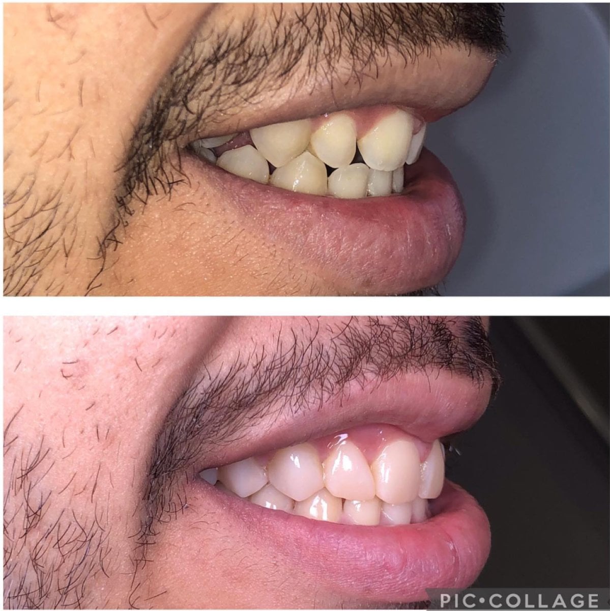 نتائج قبل وبعد الفينير المركب في Professional Dental Care Clinic، ابتسامة محسنة