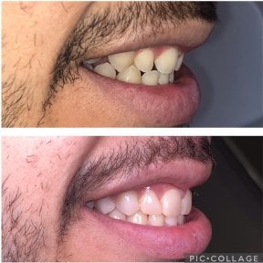 Before and after composite veneer results at Professional Dental Care Clinic, improved smile