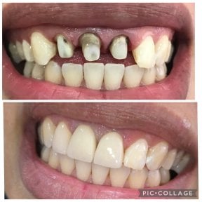 Porcelain crown installation before and after results at Professional Dental Care Clinic, smile restoration