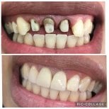 Porcelain crown installation before and after results at Professional Dental Care Clinic, smile restoration