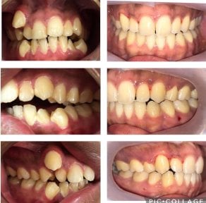 Before and after braces results at Professional Dental Care Clinic, teeth alignment improvement