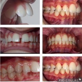 Before and after braces results at Professional Dental Care Clinic – improved teeth alignment