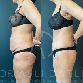 Vorher-nachher-Ergebnis Liposuktion (5 Zonen) bei Liv Hospital Ulus, verbesserte Kontur