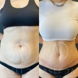 Vorher-nachher-Ergebnis Bauchdeckenstraffung bei Liv Hospital Ulus, sichtbare Konturverbesserung