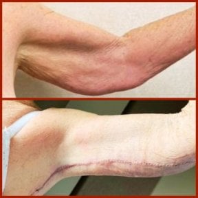 Resultados antes y después de lifting de brazos (braquioplastia) en DGB Clinic – mejor contorno