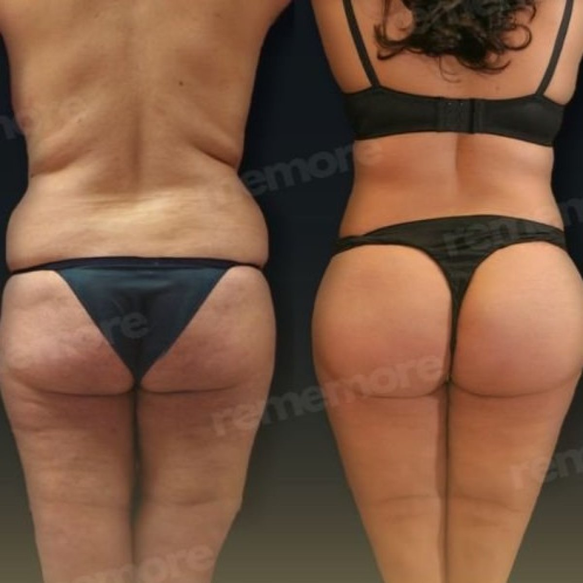 Resultados antes y después de lifting de glúteos en Memorial Bahçelievler Hospital, mejor contorno