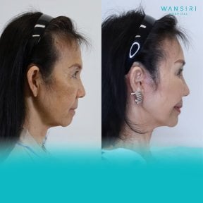 Before and after blepharoplasty results at Wansiri Hospital, eyelid correction and rejuvenation