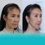 Before and after blepharoplasty results at Wansiri Hospital, eyelid correction improvement