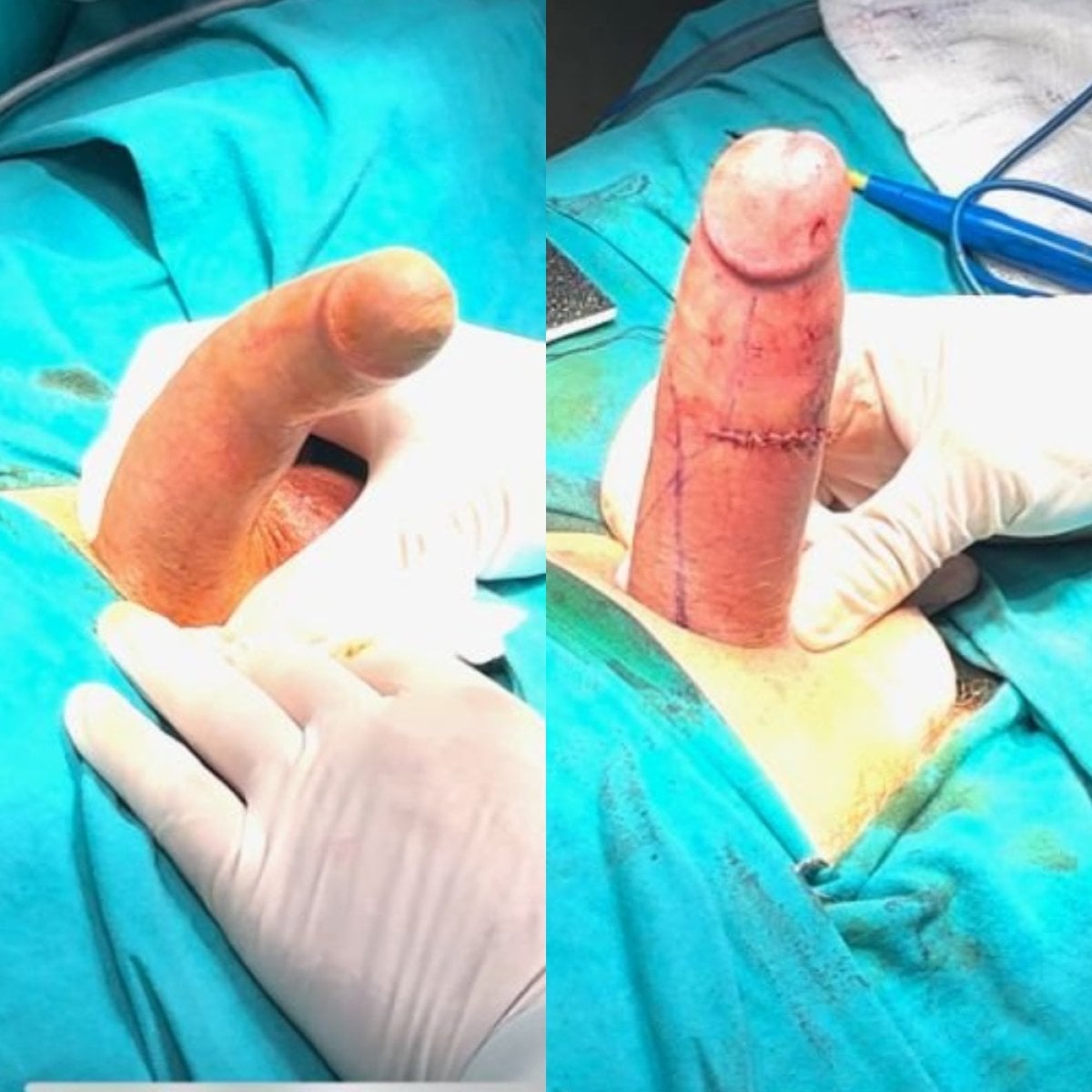 Antes y después de corrección de curvatura peneana en Uroaesthetic – resultado quirúrgico