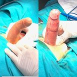 Before and after penile curvature correction at Uroaesthetic – Peyronie's disease surgery result