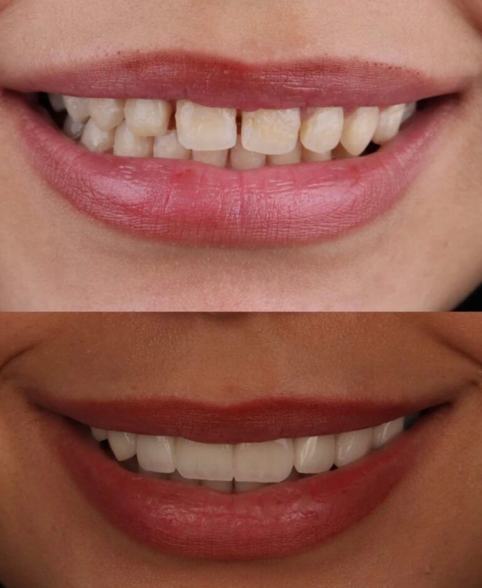 Antes y después de la colocación de coronas dentales en PyraMedicine, mejora estética