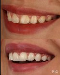 Before and after dental crown installation at PyraMedicine, improved smile aesthetics result