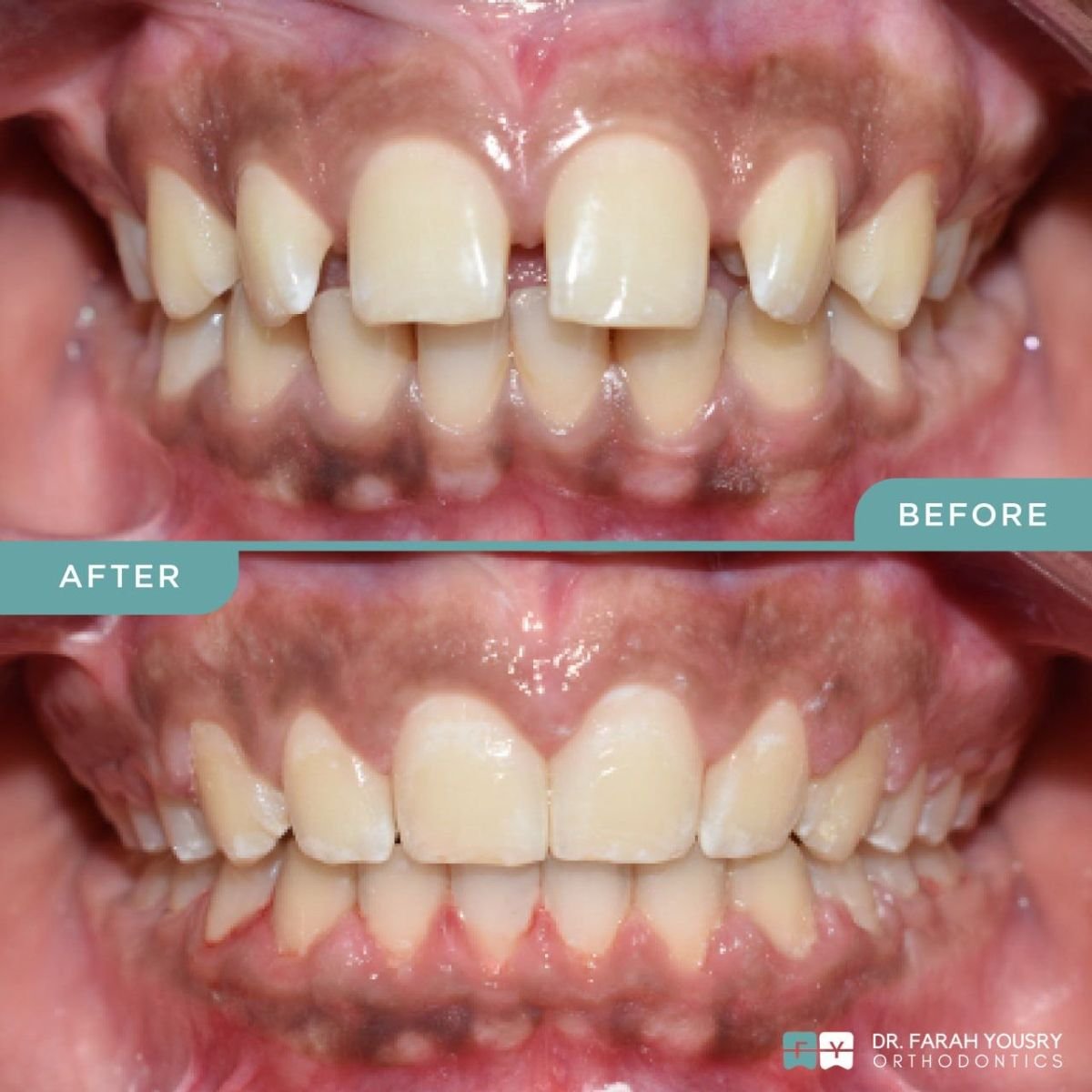Antes y después de alineadores transparentes en PyraMedicine: alineación dental y mejora de sonrisa