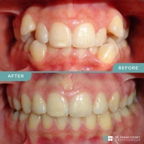 Antes y después de alineadores transparentes en PyraMedicine: resultado de alineación dental