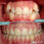 Antes y después de alineadores transparentes en PyraMedicine: resultado de alineación dental