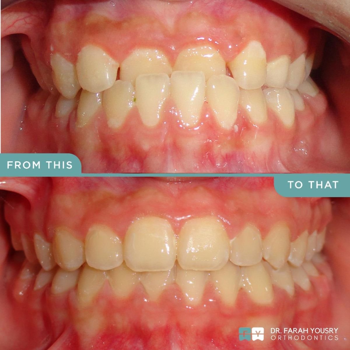 Resultado de alineadores transparentes antes y después en PyraMedicine – sonrisa mejorada