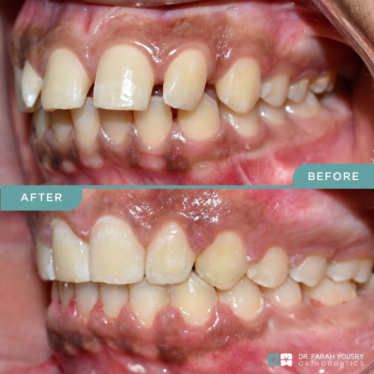 Antes y después de alineadores transparentes en PyraMedicine: resultado de alineación dental