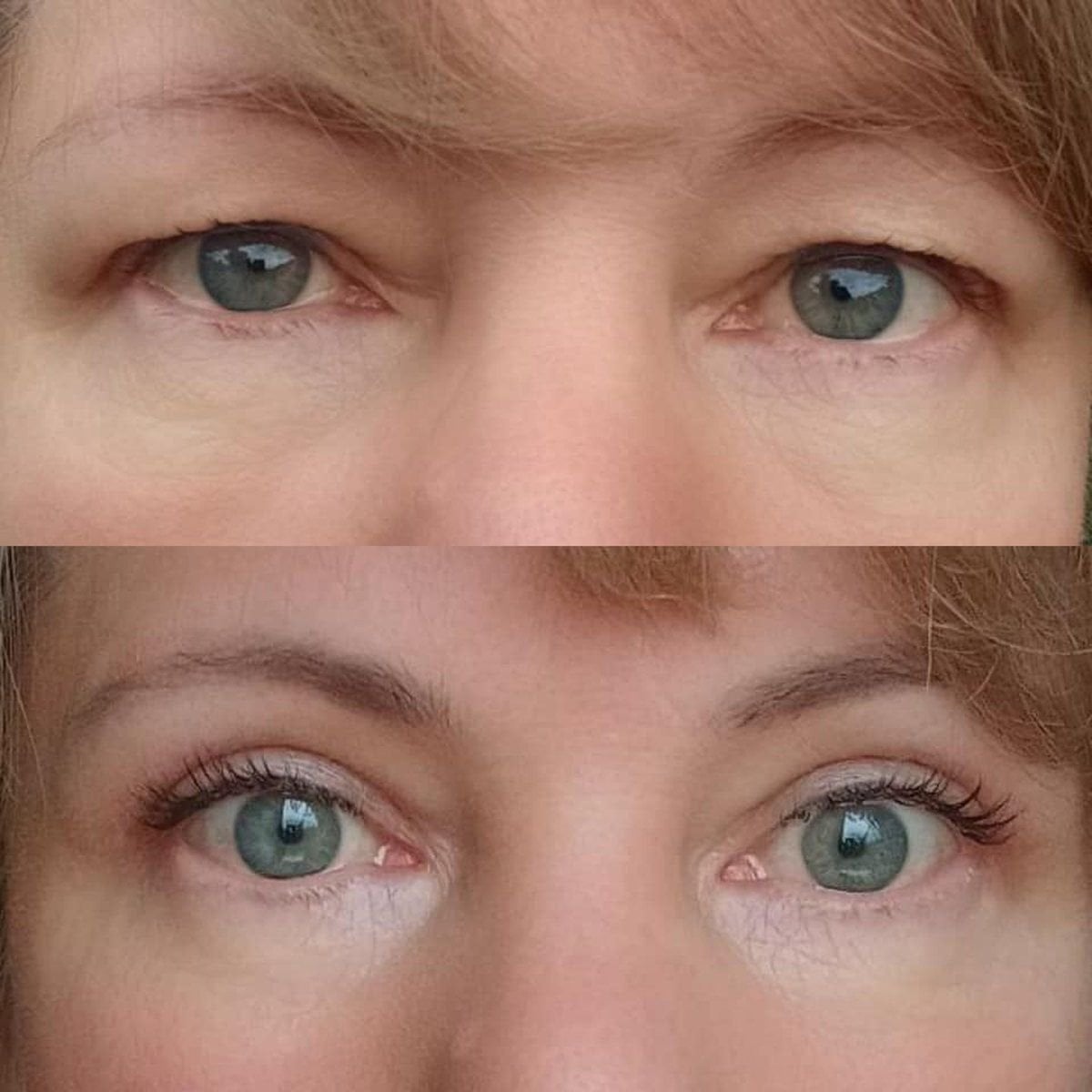 Resultados de blefaroplastia antes y después en Altos Clinic – corrección de párpados juvenil