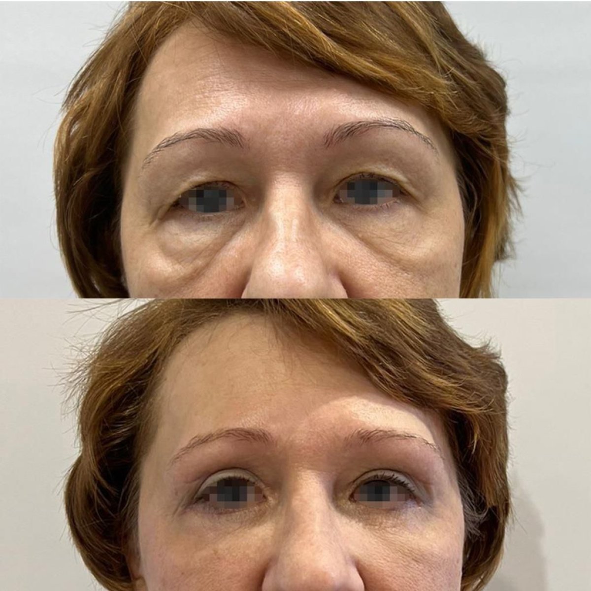 Resultados de blefaroplastia antes y después en Altos Clinic – corrección de párpados