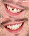 نتائج زراعة الأسنان في SmileBox – استعادة الأسنان الأمامية وتحسين الابتسامة