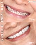 نتائج قبل وبعد زراعة سن واحدة في SmileBox – تحسين مظهر الابتسامة