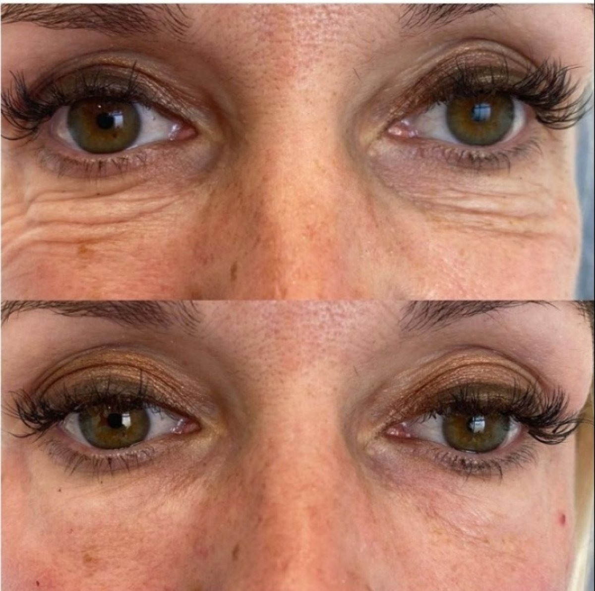 Efekty liftingu nićmi w Plenary Wellness, mniej zmarszczek wokół oczu