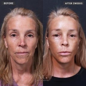 Facelift before and after results at VG Plastic Surgery, visible facial rejuvenation after 2 weeks