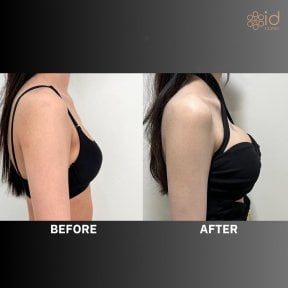 Before and after breast augmentation with silicone implants at ID Clinic Bangkok, visible results