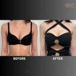 Before and after breast augmentation with silicone implants at ID Clinic Bangkok, visible results
