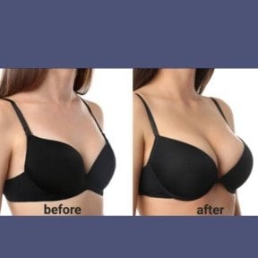 Before and after breast augmentation with silicone implants at ID Clinic Bangkok results