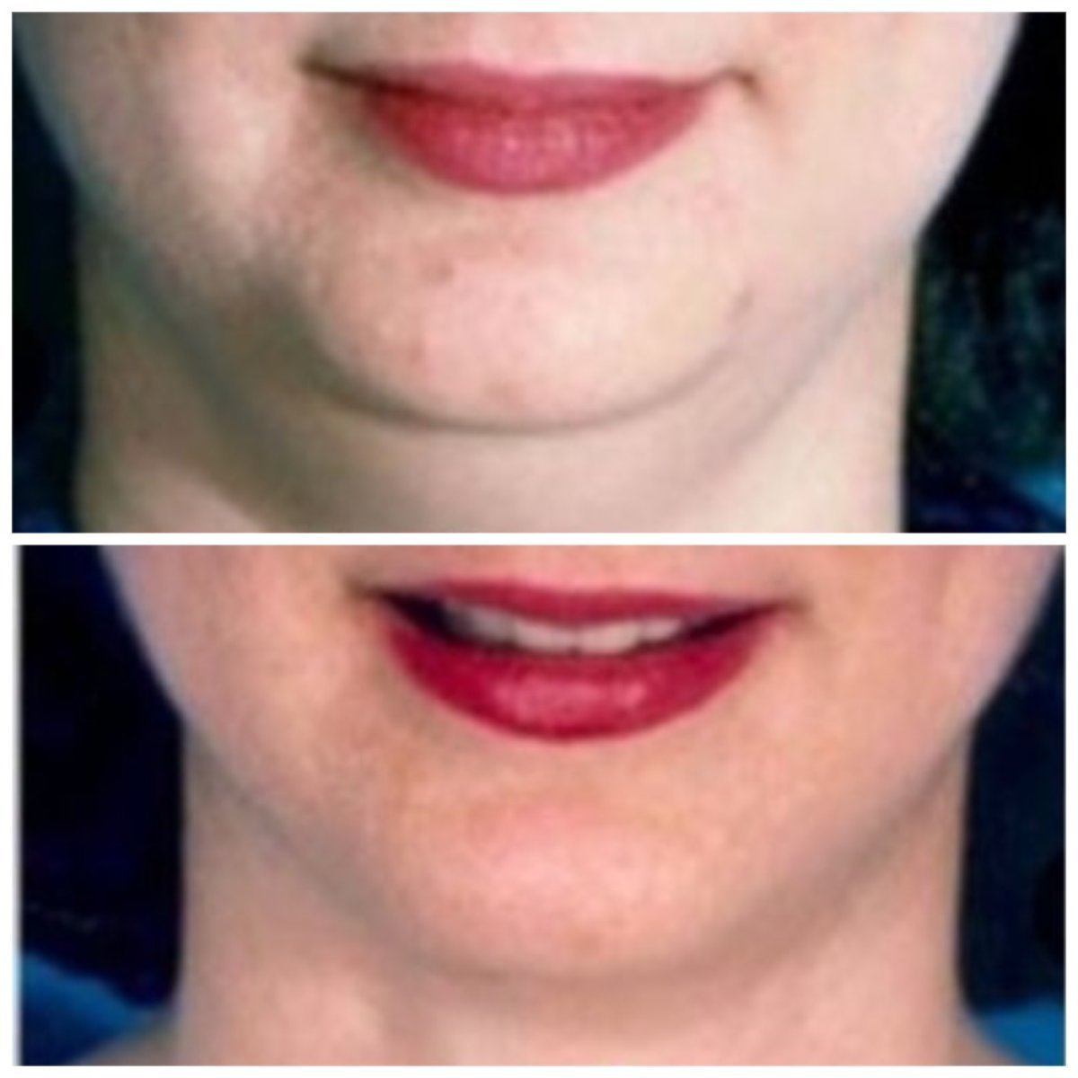 Before and after Vaser liposuction results at ID Clinic Bangkok, improved chin contour