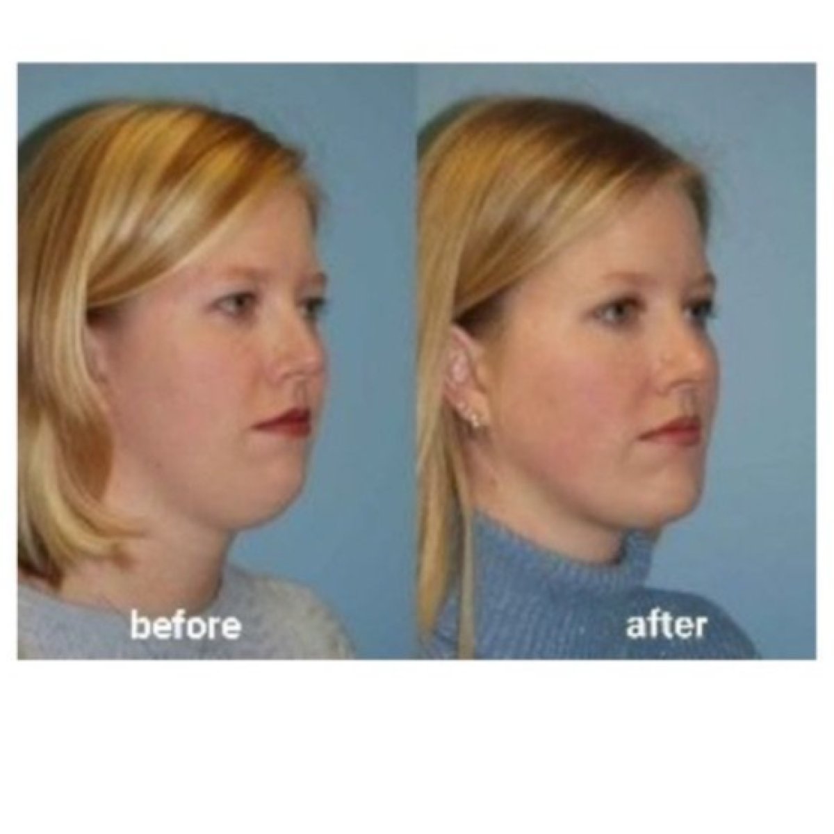 Before and after Vaser liposuction result at ID Clinic Bangkok, improved chin and jawline contour