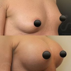 Vorher-nachher-Ergebnis Brustvergrößerung bei Dr. Safa Manav Clinic, mehr Volumen