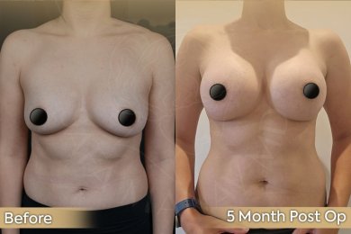 Vorher-nachher-Ergebnis Brustvergrößerung bei Dr. Safa Manav Clinic, 5 Monate post-op