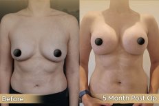 Vorher-nachher-Ergebnis Brustvergrößerung bei Dr. Safa Manav Clinic, 5 Monate post-op