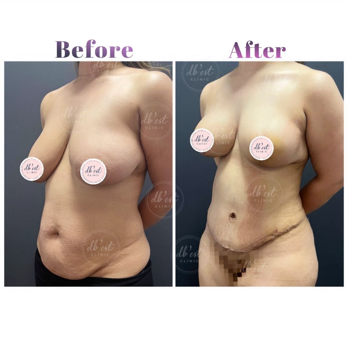 نتائج قبل وبعد عملية تجميل الأم في Db'est Clinic – نحت الثدي والبطن