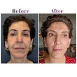 Résultats avant et après lifting du cou à Db'est Clinic, rajeunissement et contour du visage