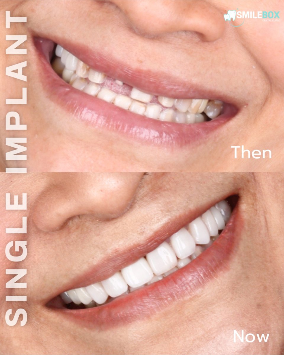 Before and after single dental implant at SmileBox clinic – improved smile result