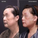 Vorher-nachher-Ergebnis endoskopisches Facelifting bei VG Plastic Surgery, sichtbare Straffung