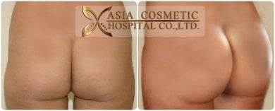 Before and after Brazilian Butt Lift results at Asia Cosmetic Hospital, enhanced buttock contour