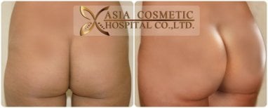 Before and after Brazilian Butt Lift results at Asia Cosmetic Hospital, enhanced buttock contour