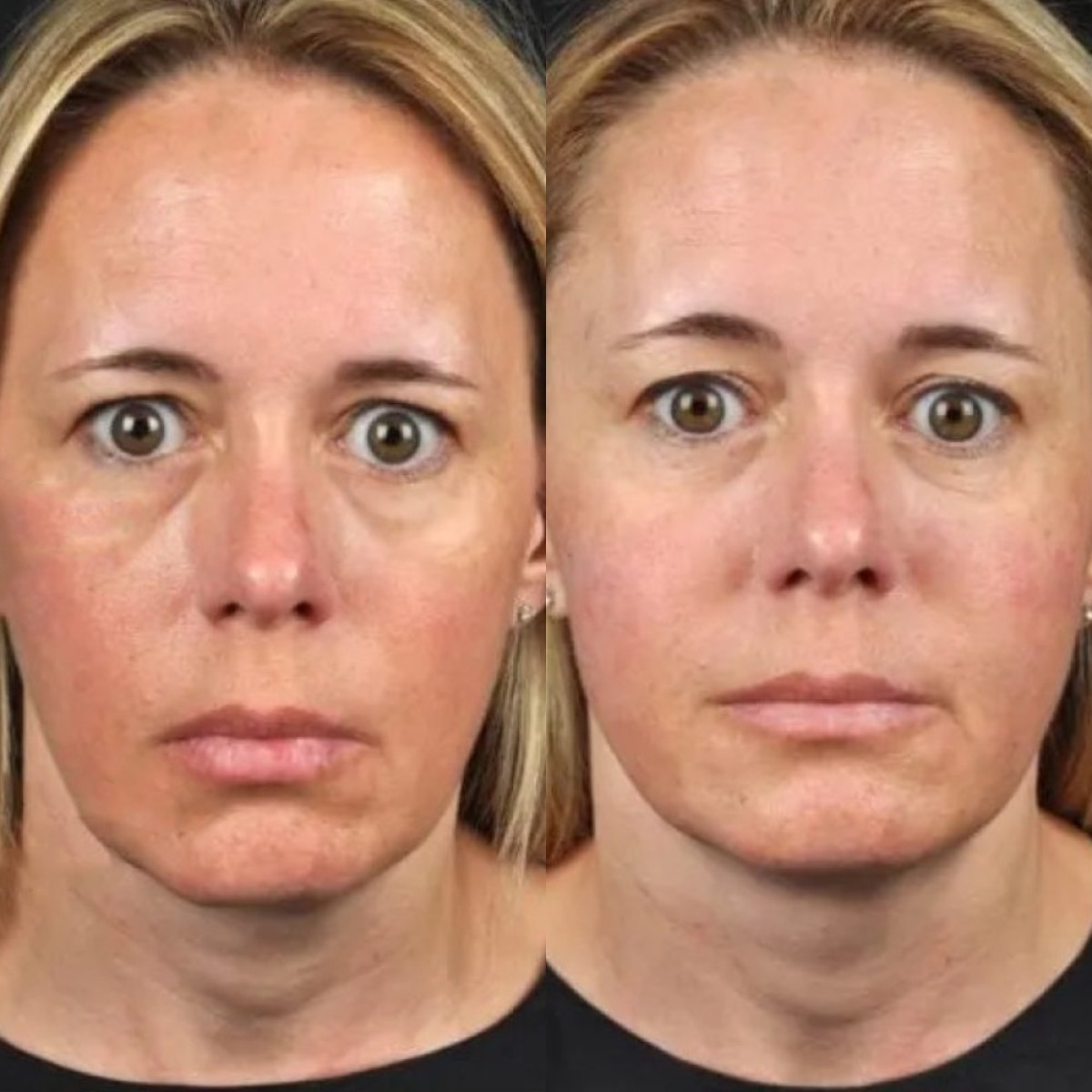 Avant et après lifting par fils chez Plenary Wellness, résultat visible de raffermissement facial