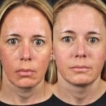 До и после нитевого лифтинга в Plenary Wellness, видимый результат подтяжки лица