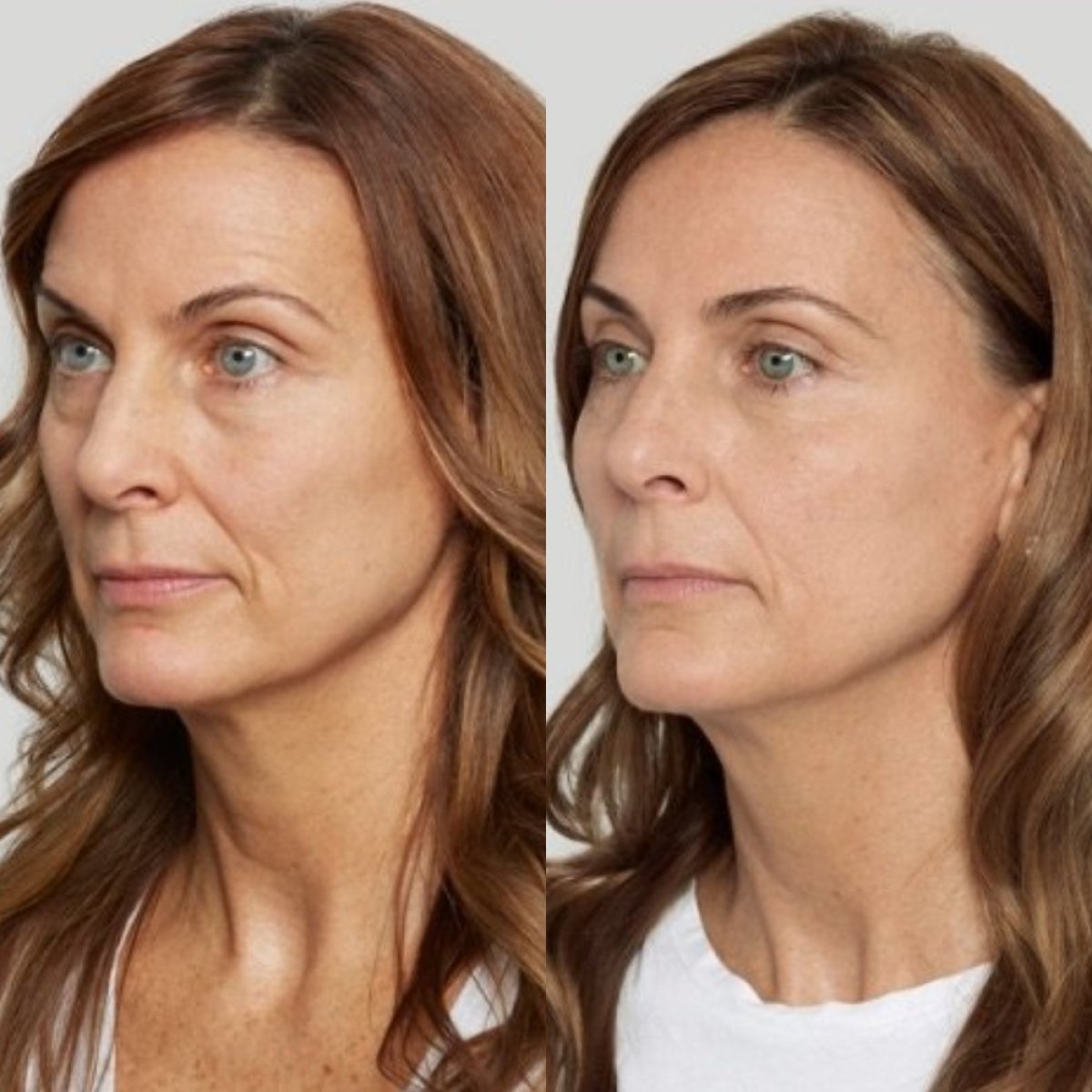 Résultats avant/après lifting par fils chez Plenary Wellness, raffermissement du visage